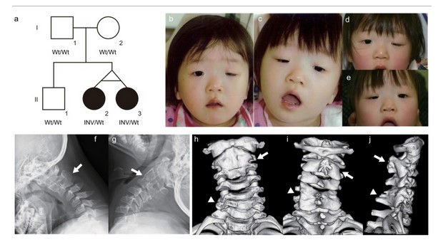 图1 患ID双胞胎的临床特征.jpg